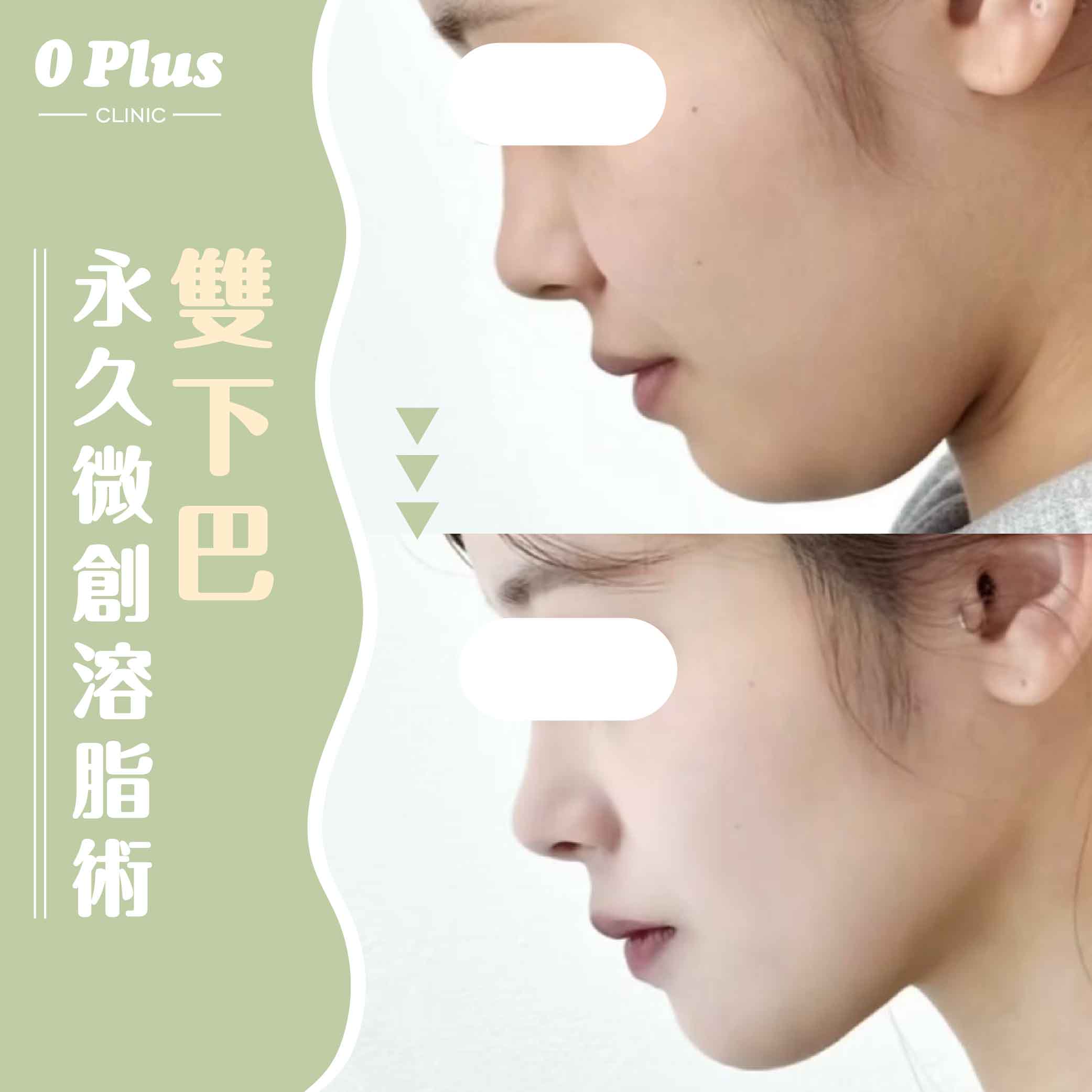 【常見Q&A】什麼是天鵝頸手術？