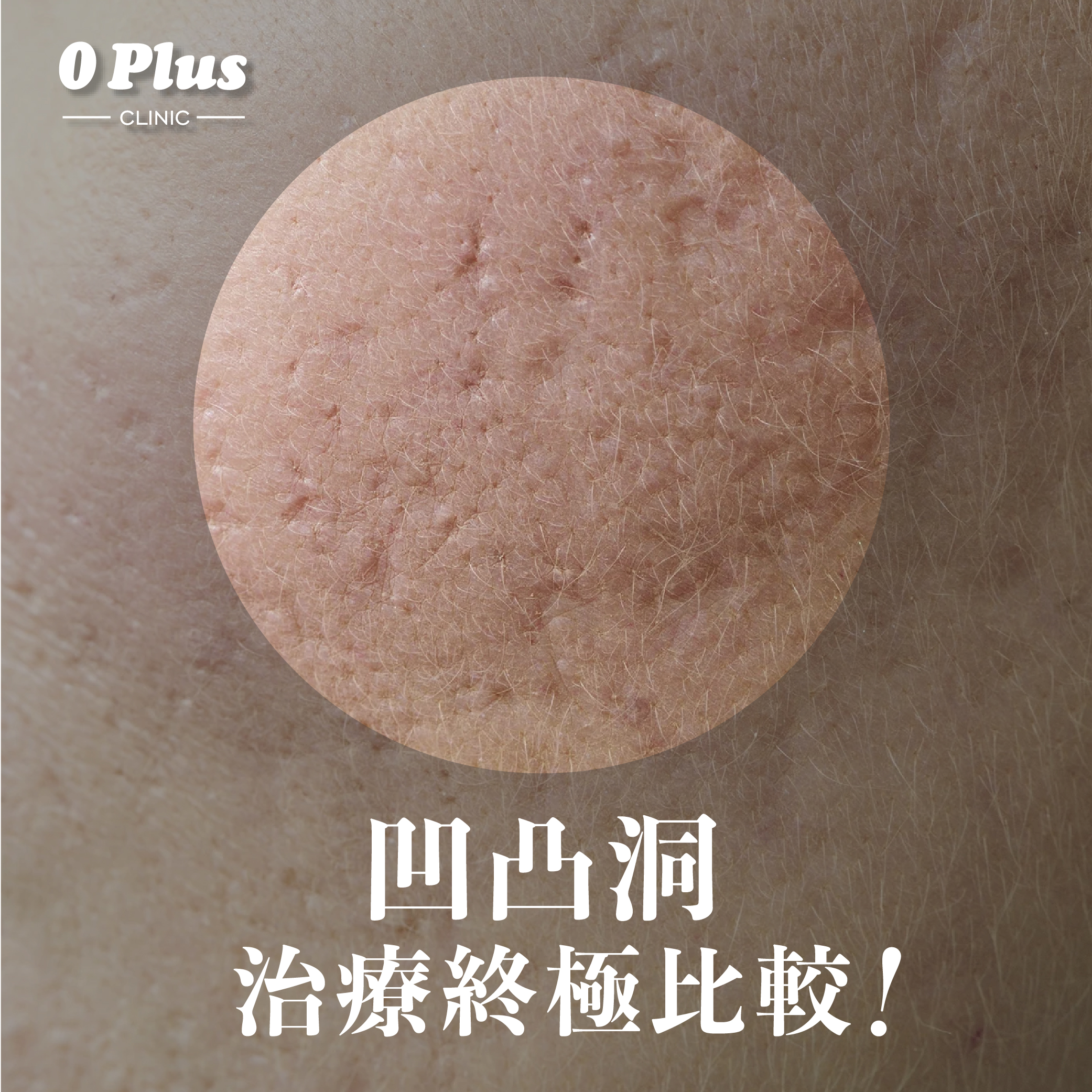 【凹凸洞治療終極比較】微針射頻、Juvelook素顏針、化學換膚與皮下切割術全解析