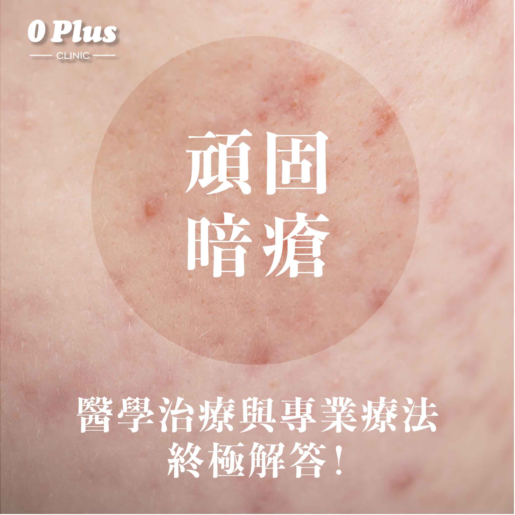 頑固暗瘡怎麼辦？醫學治療與專業療法的終極解答，教你如何打破痘痘惡性循環！